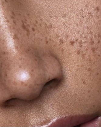 Micropigmentación de pecas en Bilbao, pecas de aspecto natural con pigmentos cosméticos semipermanentes