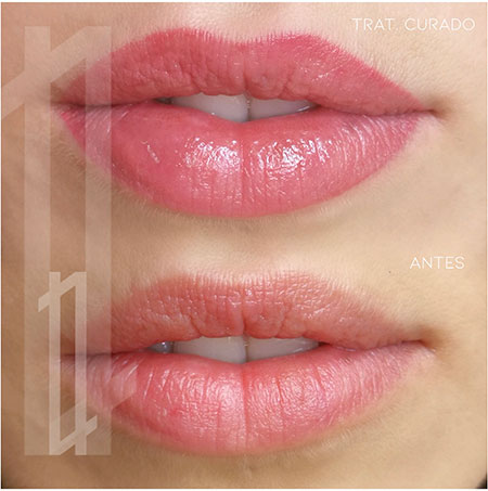 Ejemplo de resultados de micropigmentación de labios
