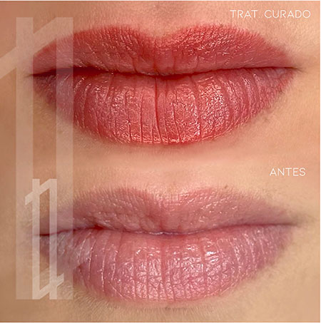 antes y después micropigmentación de labios en Bilbao