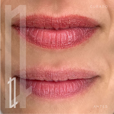 labios realzados mediante micropigmentación