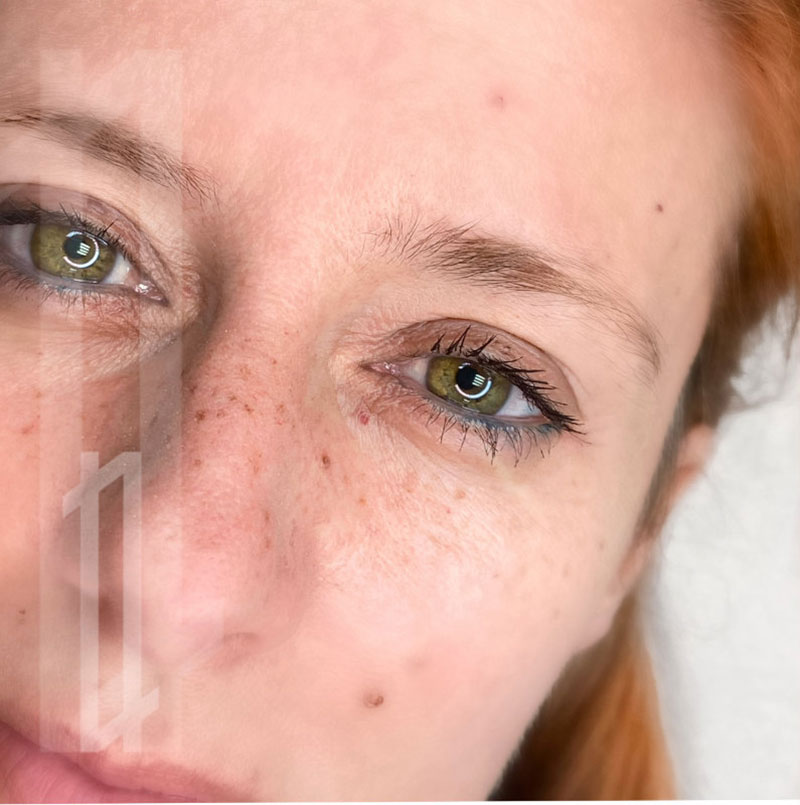 micropigmentación de pecas en la cara en Bilbao