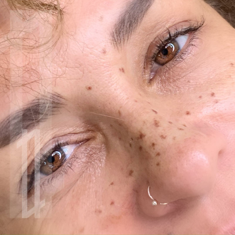 micropigmentación de pecas en la cara en Bilbao