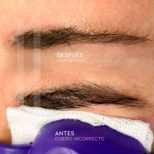Borrado de micropigmentación de cejas