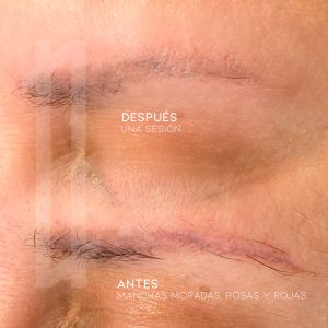 Eliminación de manchas de micropigmentación de cejas