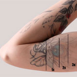 Borrar tatuajes en Bilbao