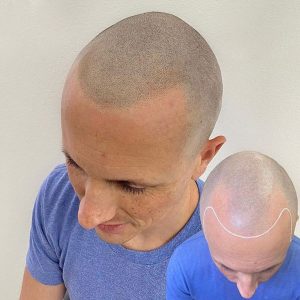 Efecto micropigmentación capilar
