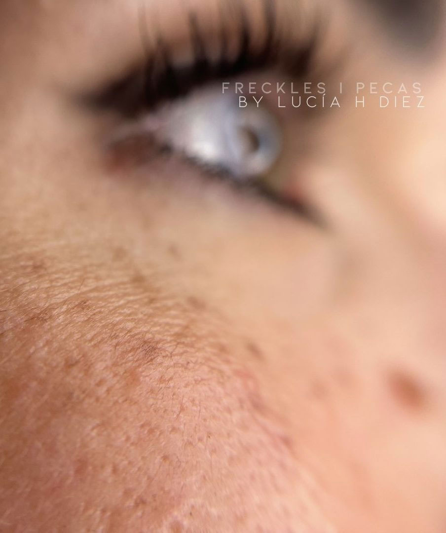 micropigmentación de pecas en Bilbao