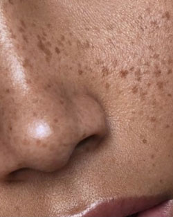 micropigmentación de pecas en Bilbao